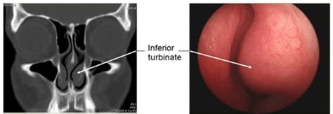 Septoplasty and Turbinate Reduction - SinusHealth