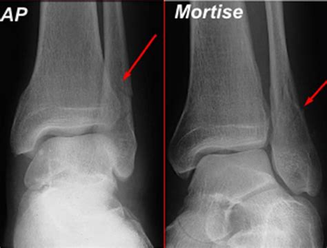 Isolated lateral malleolus fracture