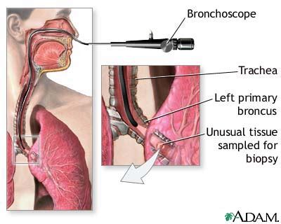 Cure Lung Cancer Now: Flexible Bronchoscope / Rigid Bronchoscope