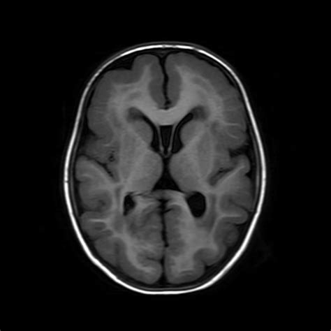 Lissencephaly-MRI - Sumer's Radiology Blog