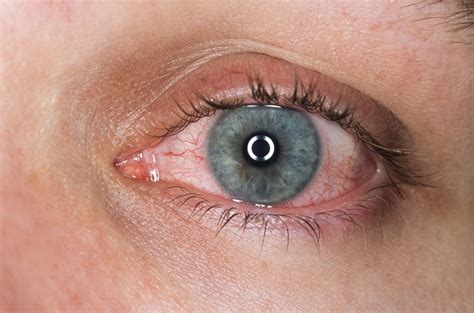 Corticosteroids May Be Overprescribed as Uveitis Treatment ...