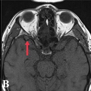 Axial T2 (A), T1 pre-contrast (B), and T1 post-contrast (C) MRI images ...