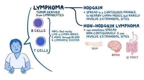 Hodgkin's lympnoma - MEDizzy