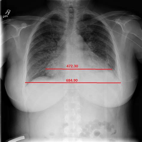 CXR Cardiomegaly Detection - Grand Challenge