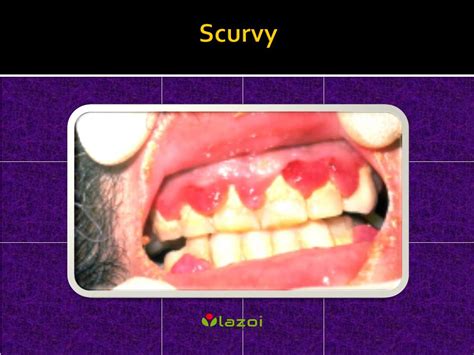 PPT - Scurvy: Causes, Symptoms, Daignosis, Prevention and Treatment ...