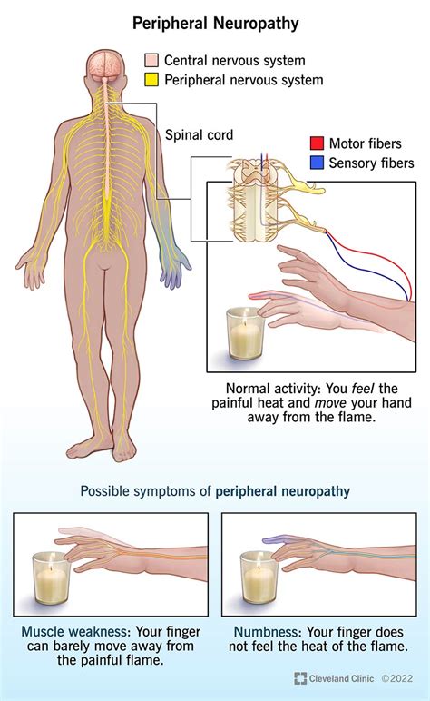 Peripheral Neuropathy: What It Is, Symptoms & Treatment