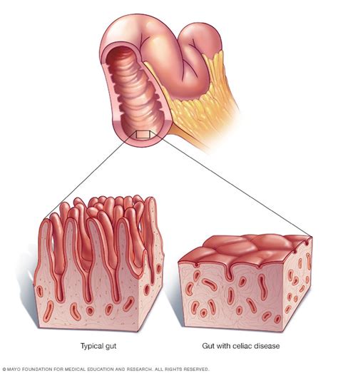 Celiac disease - Mayo Clinic