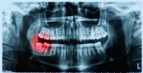 Impacted Canine | Impacted Canine Surgery Cost | Impacted Canines