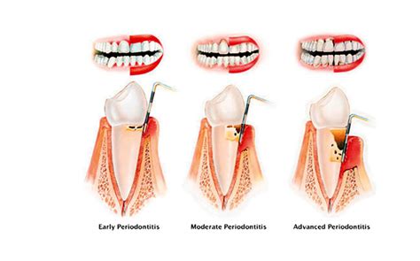 Florida Probe in Palm Beach, FL | Florida Probe Dentist Clinic