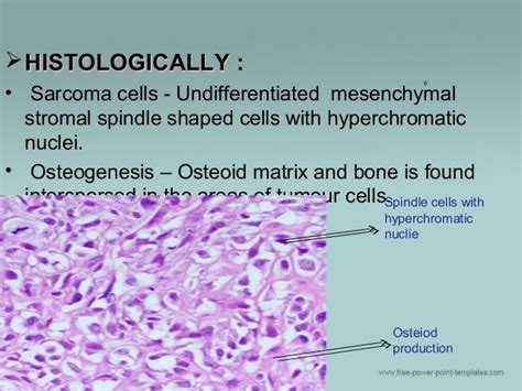 Histology Of Osteosarcoma