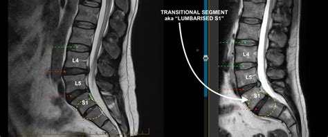 “Lumbarised S1” – The transitional (potentially mobile) lumbosacral ...