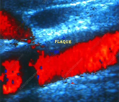 Atheroma plaque, doppler ultrasound - Stock Image M175/0335 - Science ...