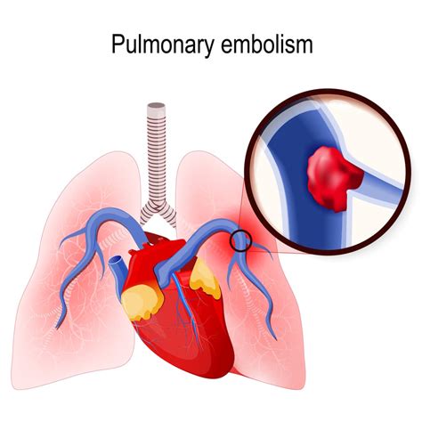 Pulmonary Embolism: What You Need to Know