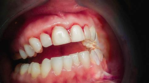 Gingivitis Gums: Symptoms, Treatment, and Prevention