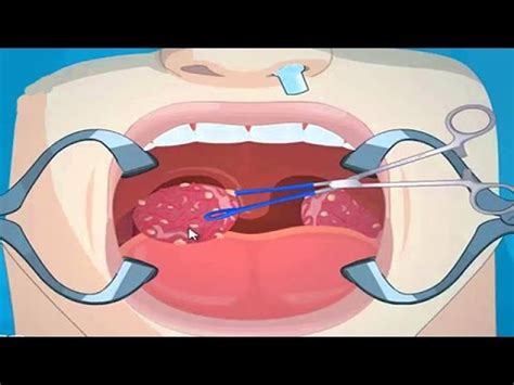 Tonsil Removal Surgery Tonsillectomy - YouTube