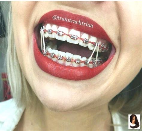 Braces That Make Your Teeth Look Whiter - Find Property to Rent