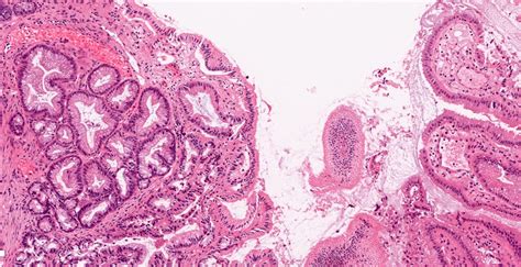 Pathology Outlines - Chronic cholecystitis