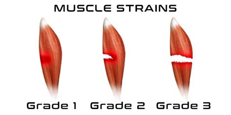 Muscle Strain Grading: Traditional Grading versus Modern Approach ...