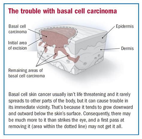 Basal Cell Carcinoma Utah County | Dr. David Myers