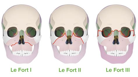 Maxillary Fracture Classification