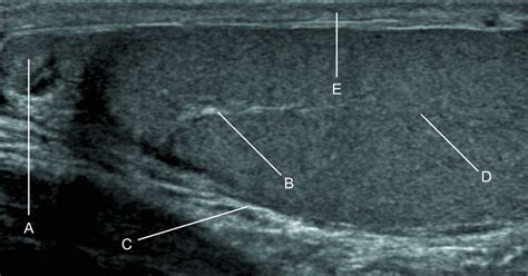 The Mediastinum Of Testis Ultrasound