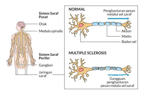 Multiple Sclerosis - Gejala, penyebab dan mengobati - Alodokter