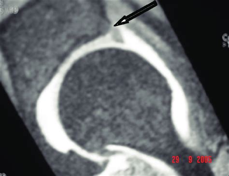 mri arthrogram hip labral tear – acetabular labral tear mri – Aep22