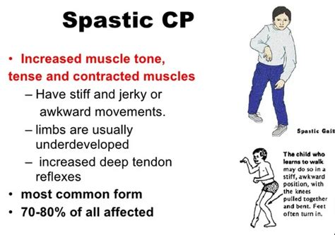 Spastic Cerebral Palsy - Cause, Symptoms, Treatment, Exercise