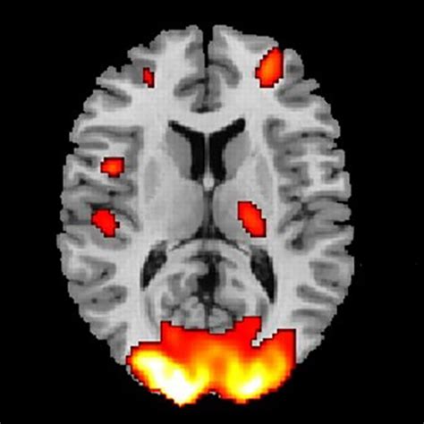 Brain Fmri Scan