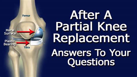 After Partial Knee Replacement Surgery: Answers To Your Questions - YouTube