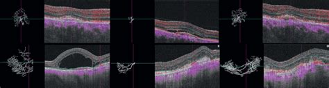 Treatment-naïve choroidal neovascularization (CNV) in AMD before and ...