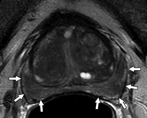 What You Need to Know Before Reading Multiparametric MRI for Prostate ...