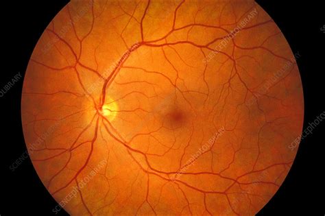 Healthy eye, fundus image - Stock Image - C026/1049 - Science Photo Library