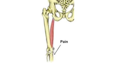 Pes Anserine Bursitis & Tendinopathy - Sportsinjuryclinic.net