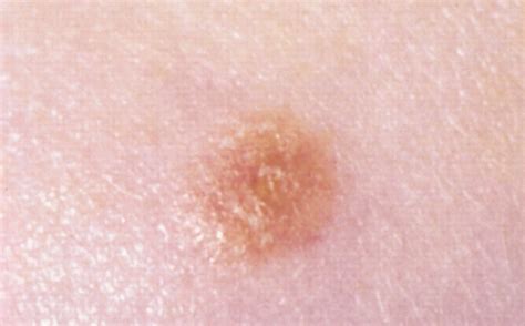 File:Spitz nevus.jpg - Wikimedia Commons