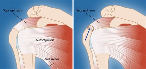 Supraspinatus Muscle Tear