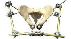 Pelvic External Fixation