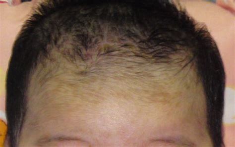 Cradle Cap in Adults – Can Adults Get Cradle Cap? Symptoms, Treatment ...