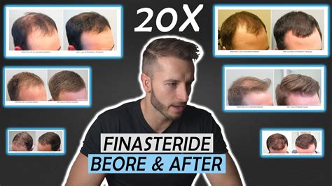 20 Finasteride Before And After Results! NW1 - NW5/NW6 - YouTube