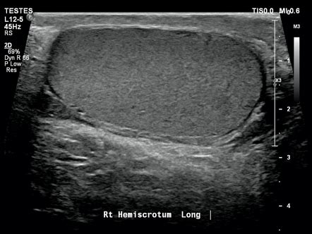 Normal Epididymis Ultrasound