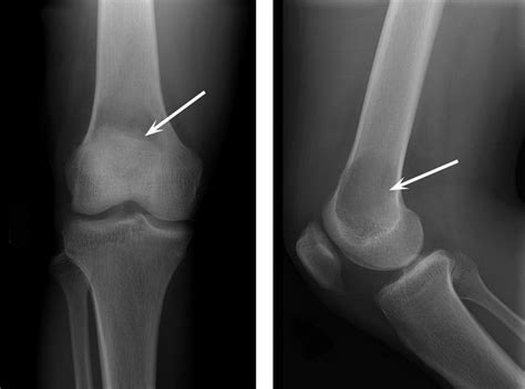 Giant Cell Tumor of Bone - OrthoInfo - AAOS