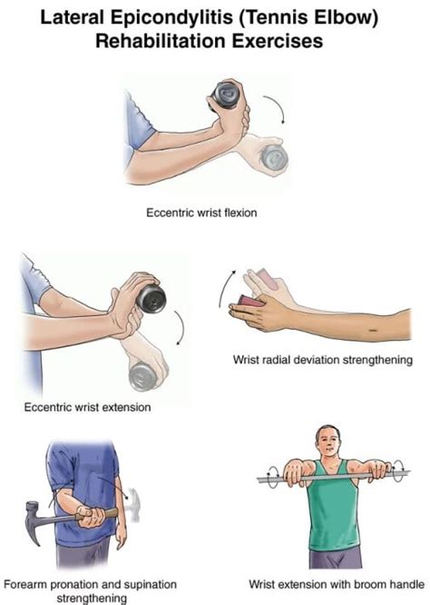 Lateral Epicondylitis Tennis Elbow Exercises