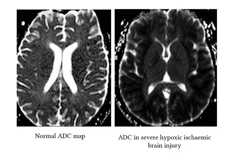 Radiological findings in hypoxic ischaemic encephalopathy | Deranged ...