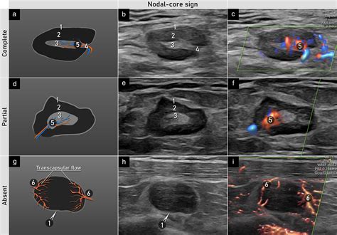 Terms, definitions and measurements to describe sonographic features of ...