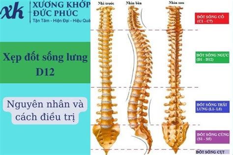 Xẹp đốt sống lưng D12 là gì? Triệu chứng và nguyên nhân gây bệnh