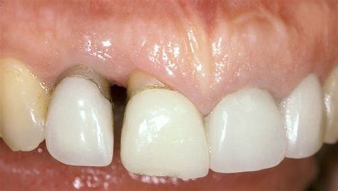 Papilla Reconstruction | Dr. Peter Nordland | Periodontist