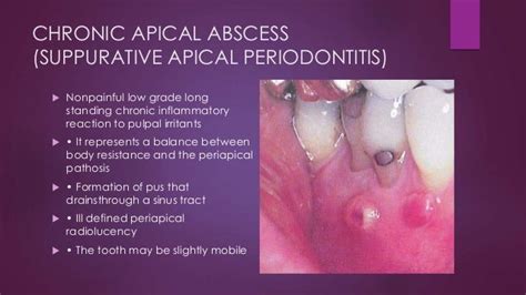 Pulp and periapical disease