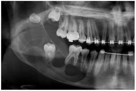 Dentistry Journal | Free Full-Text | Unusual Imaging Features of ...