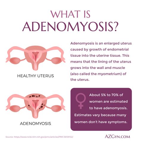 Adenomyosis Risk Factors | Adenomyosis Causes and Symptoms