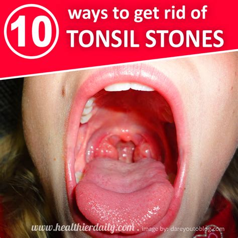 how to prevent tonsil stones